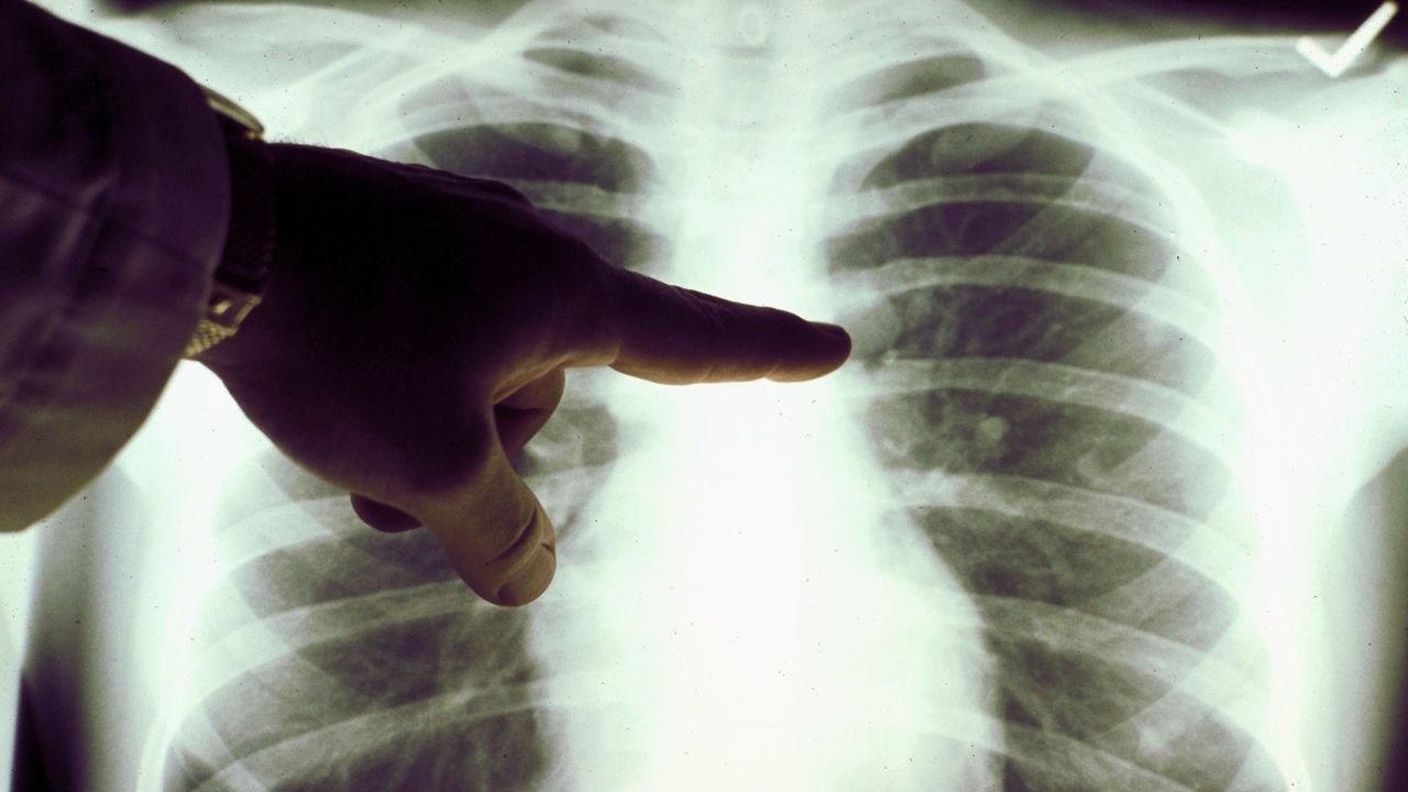 Tumore al polmone, al San Camillo di Roma c'è un progetto per la diagnosi precoce