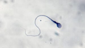 La prima gravidanza al mondo ottenuta grazie all'intelligenza artificiale capace di scovare gli spermatozoi vitali (e a un robot)