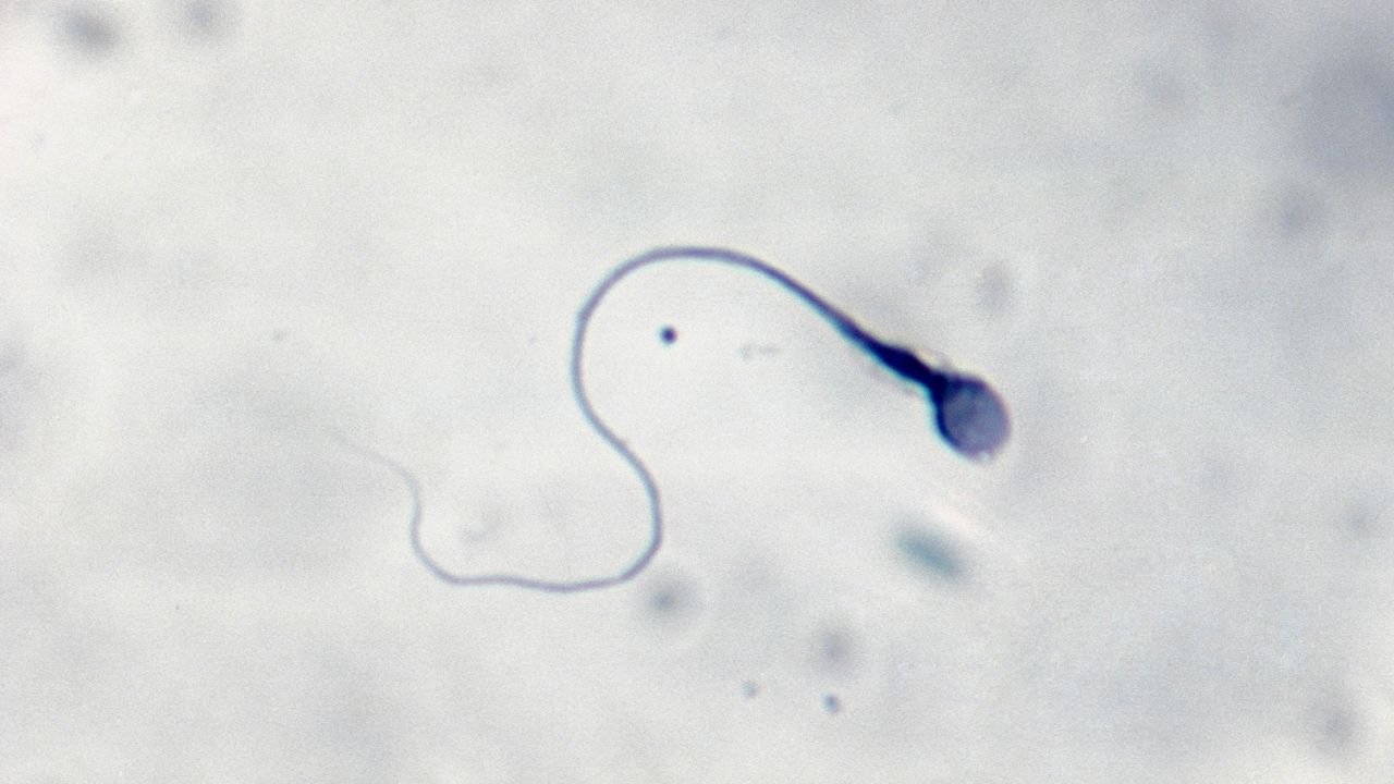 La prima gravidanza al mondo ottenuta grazie all'intelligenza artificiale capace di scovare gli spermatozoi vitali (e a un robot)